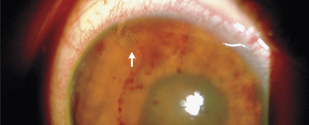 eye-worm-teen-in-mexico_1024.jpg